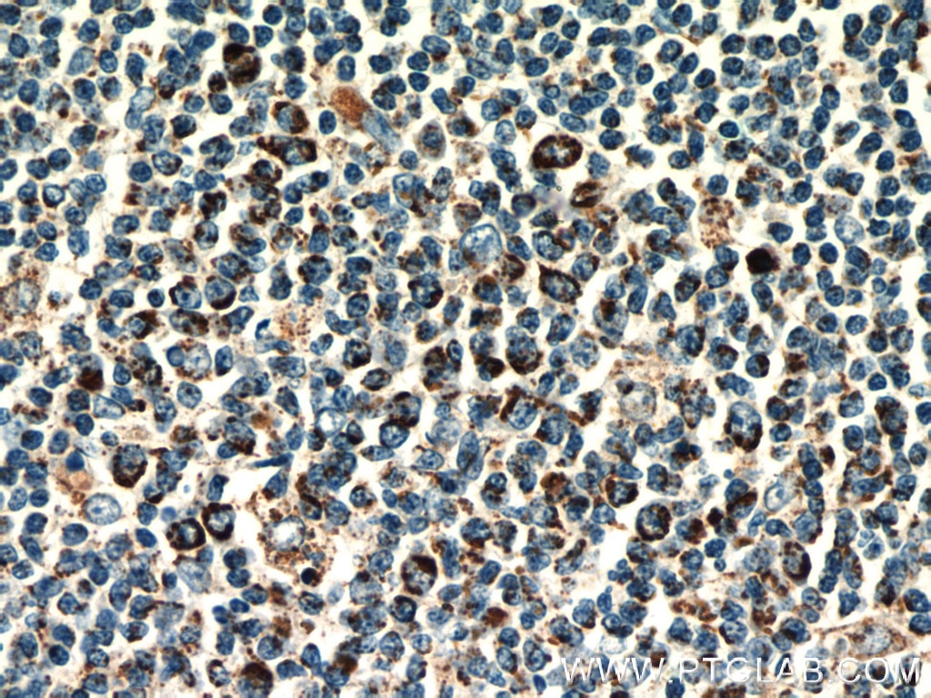 Immunohistochemistry (IHC) staining of human tonsillitis tissue using LPXN Polyclonal antibody (11307-1-AP)