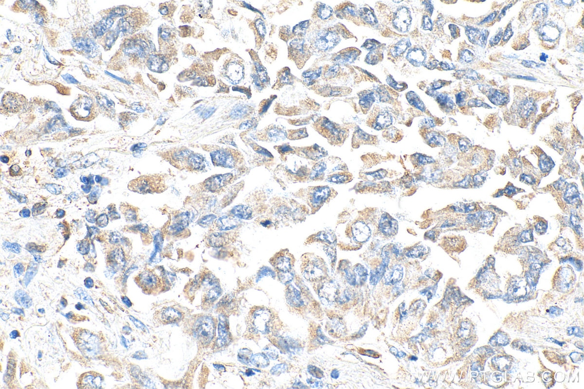 Immunohistochemistry (IHC) staining of human lung cancer tissue using LPXN Polyclonal antibody (11307-1-AP)