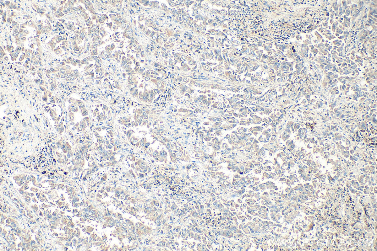 Immunohistochemistry (IHC) staining of human lung cancer tissue using LPXN Polyclonal antibody (11307-1-AP)