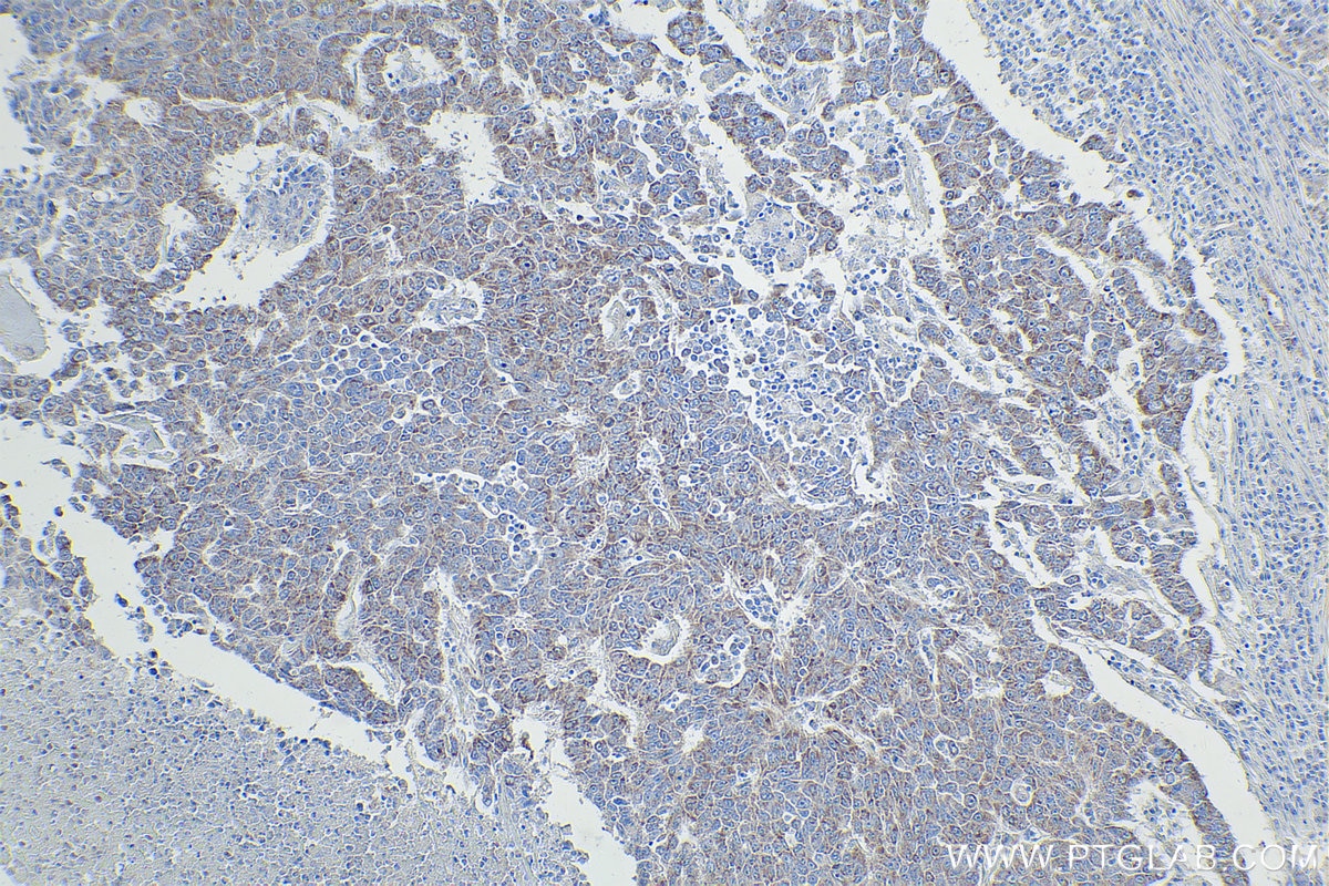 Immunohistochemistry (IHC) staining of human lung cancer tissue using LRDD Polyclonal antibody (12119-1-AP)