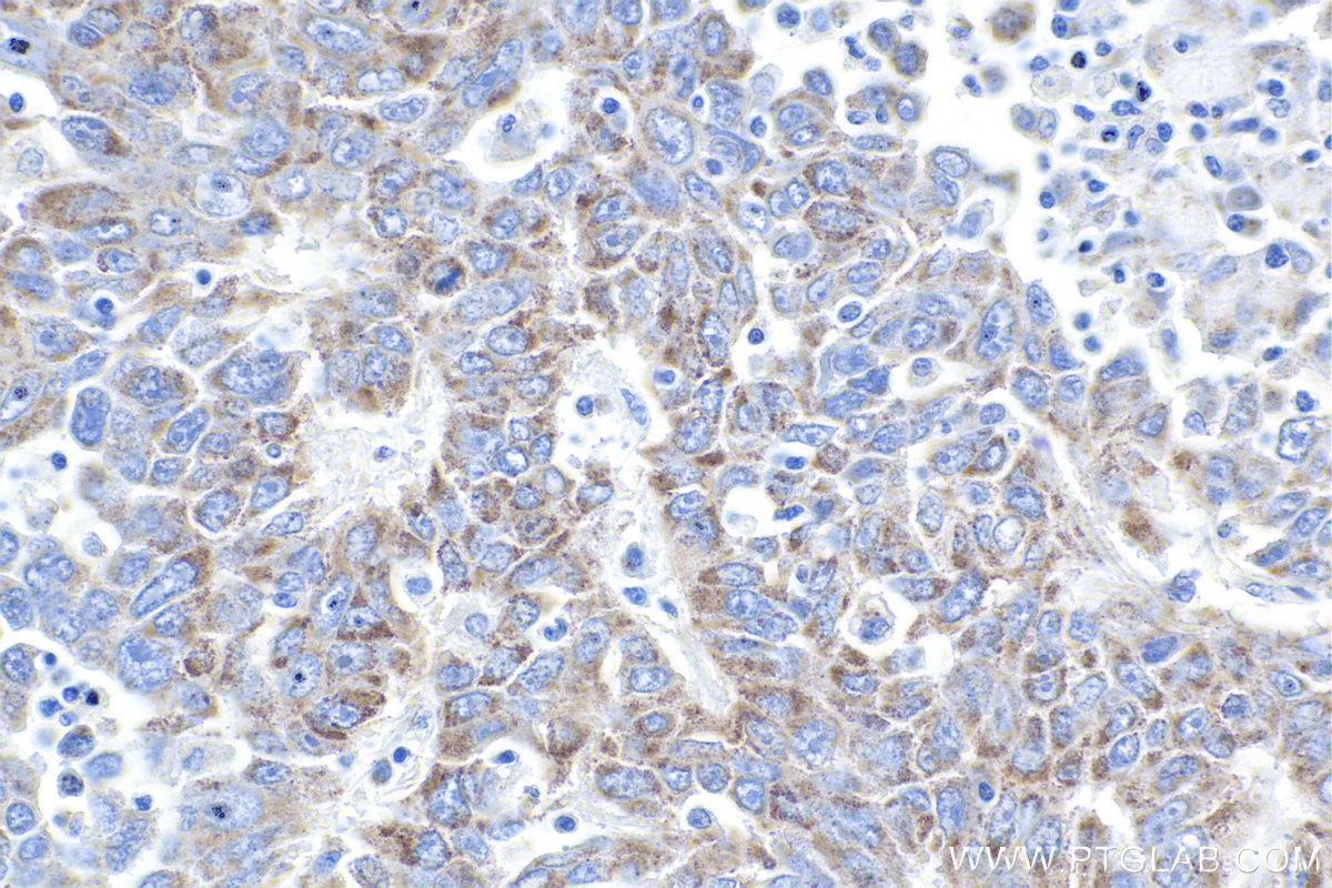 Immunohistochemistry (IHC) staining of human lung cancer tissue using LRDD Polyclonal antibody (12119-1-AP)