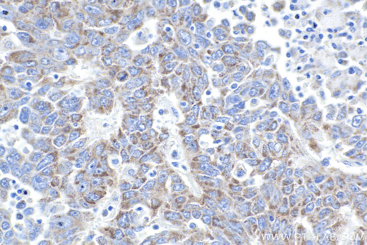 IHC staining of human lung cancer using 12119-1-AP