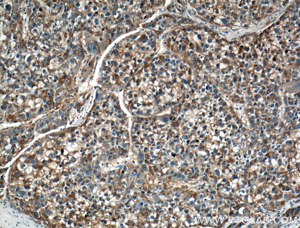 Immunohistochemistry (IHC) staining of human liver cancer tissue using LRG1 Polyclonal antibody (13224-1-AP)