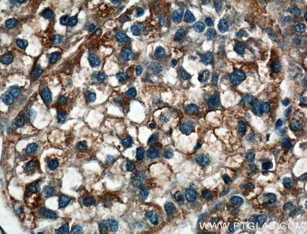 Immunohistochemistry (IHC) staining of human liver cancer tissue using LRG1 Polyclonal antibody (13224-1-AP)