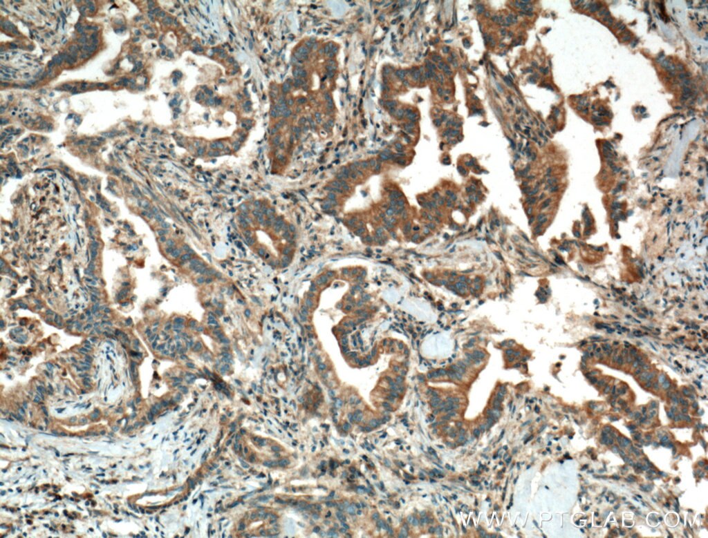 Immunohistochemistry (IHC) staining of human pancreas cancer tissue using LRG1 Polyclonal antibody (13224-1-AP)