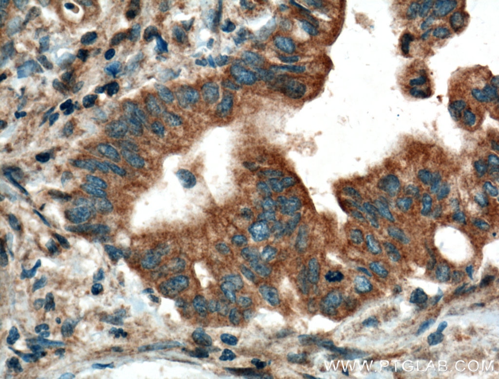 IHC staining of human pancreas cancer using 13224-1-AP