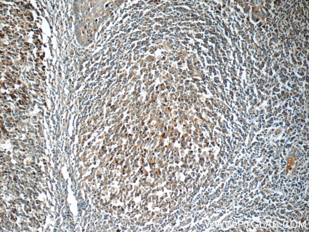 Immunohistochemistry (IHC) staining of human tonsillitis tissue using LRMP Polyclonal antibody (24772-1-AP)