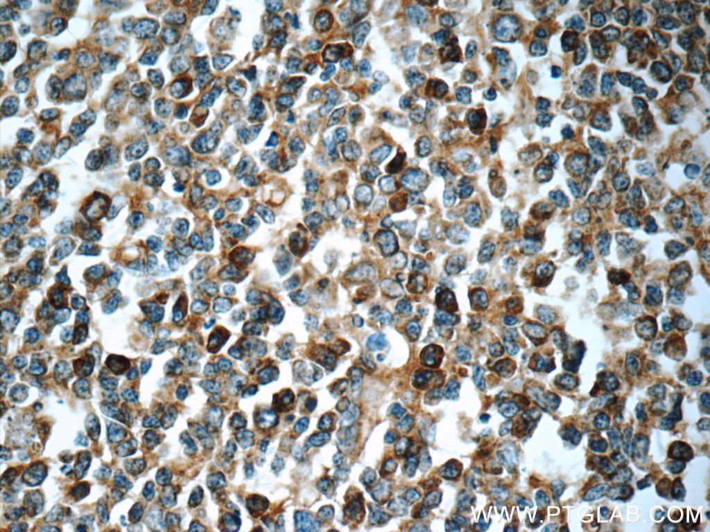 Immunohistochemistry (IHC) staining of human tonsillitis tissue using LRMP Polyclonal antibody (24772-1-AP)