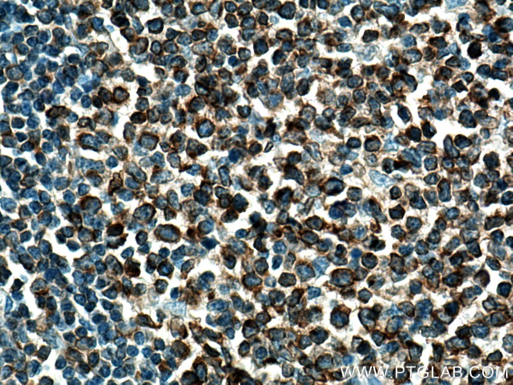 Immunohistochemistry (IHC) staining of human tonsillitis tissue using LRMP Polyclonal antibody (24772-1-AP)