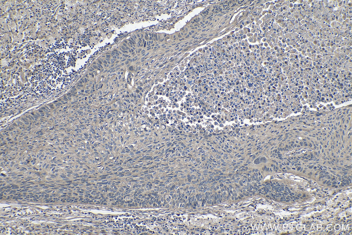 Immunohistochemistry (IHC) staining of human lung cancer tissue using PTPRA Polyclonal antibody (13079-1-AP)
