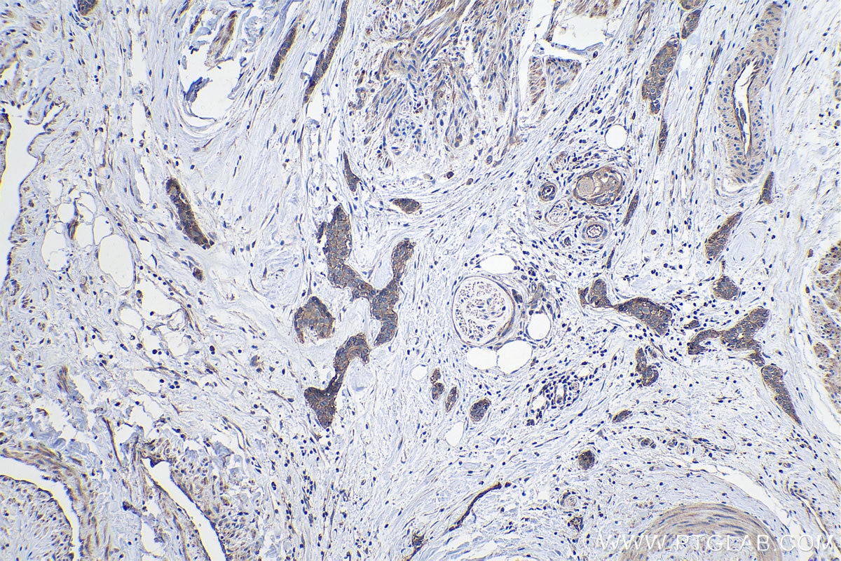Immunohistochemistry (IHC) staining of human urothelial carcinoma tissue using PTPRA Polyclonal antibody (13079-1-AP)