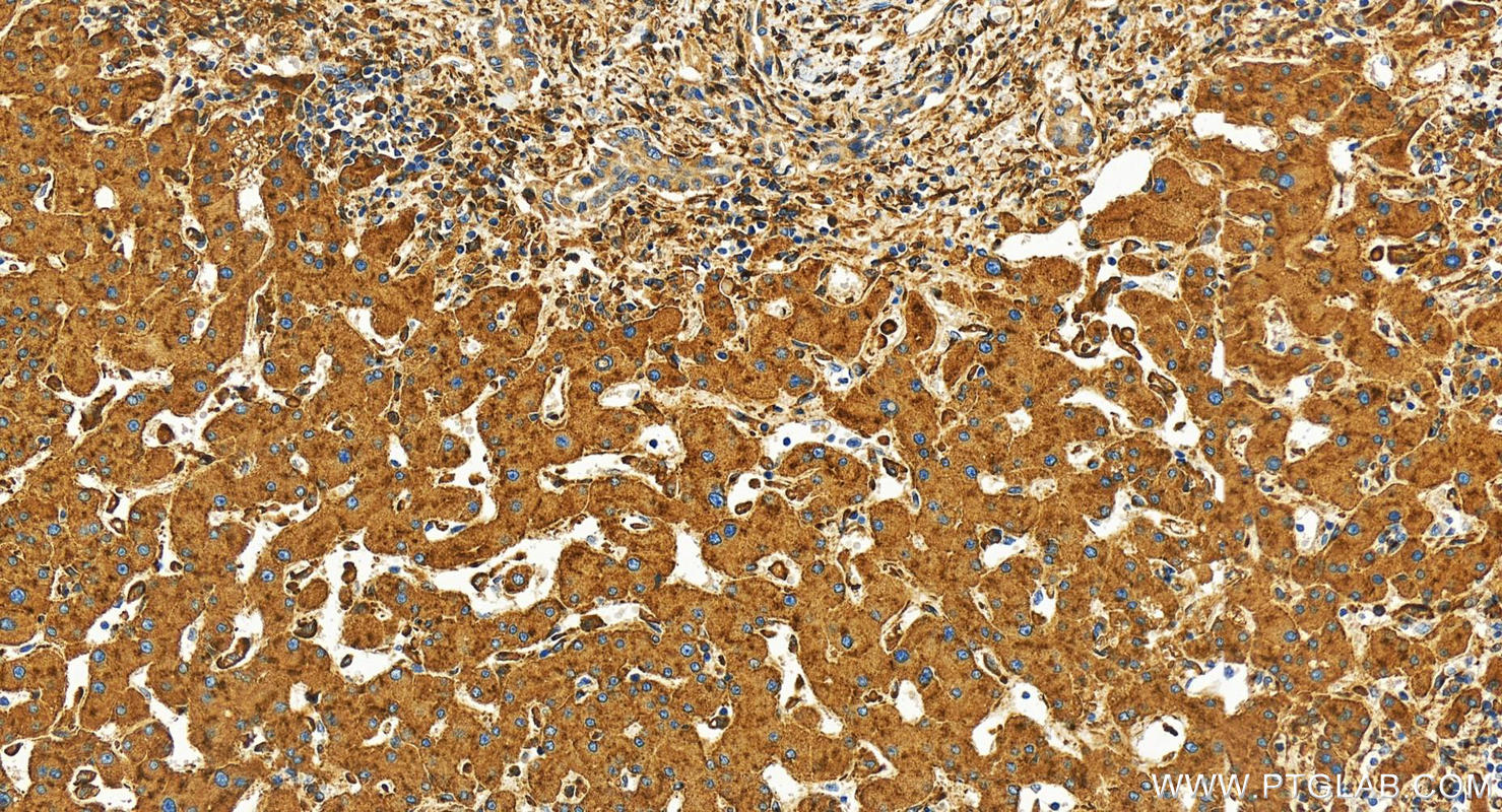 Immunohistochemistry (IHC) staining of human intrahepatic cholangiocarcinoma tissue using LRP1 Polyclonal antibody (30206-1-AP)