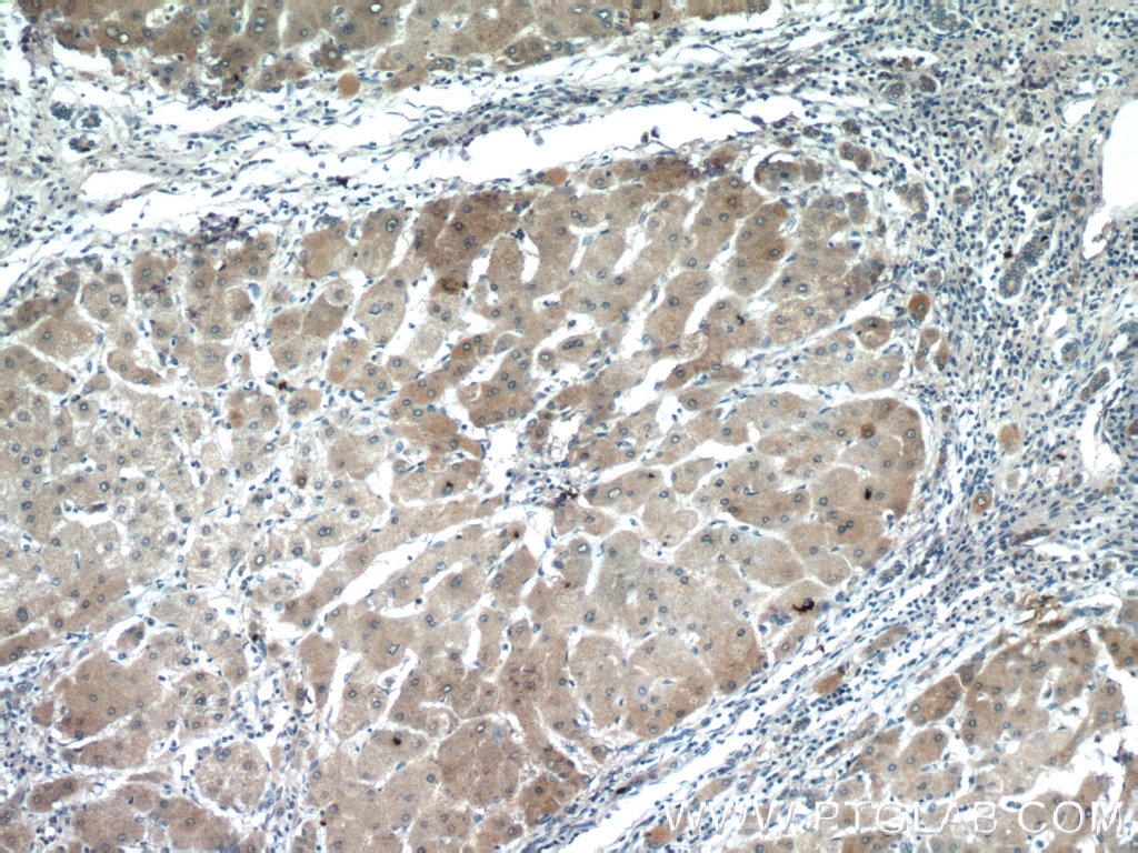 Immunohistochemistry (IHC) staining of human hepatocirrhosis tissue using LRP5 Polyclonal antibody (24899-1-AP)