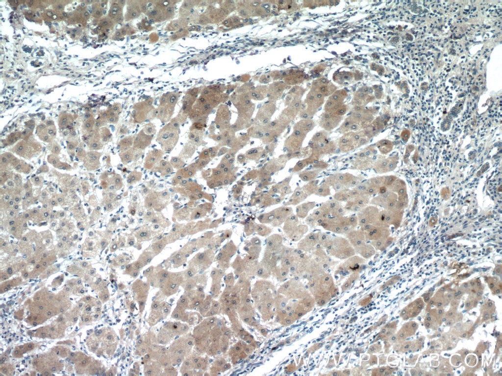 IHC staining of human hepatocirrhosis using 24899-1-AP