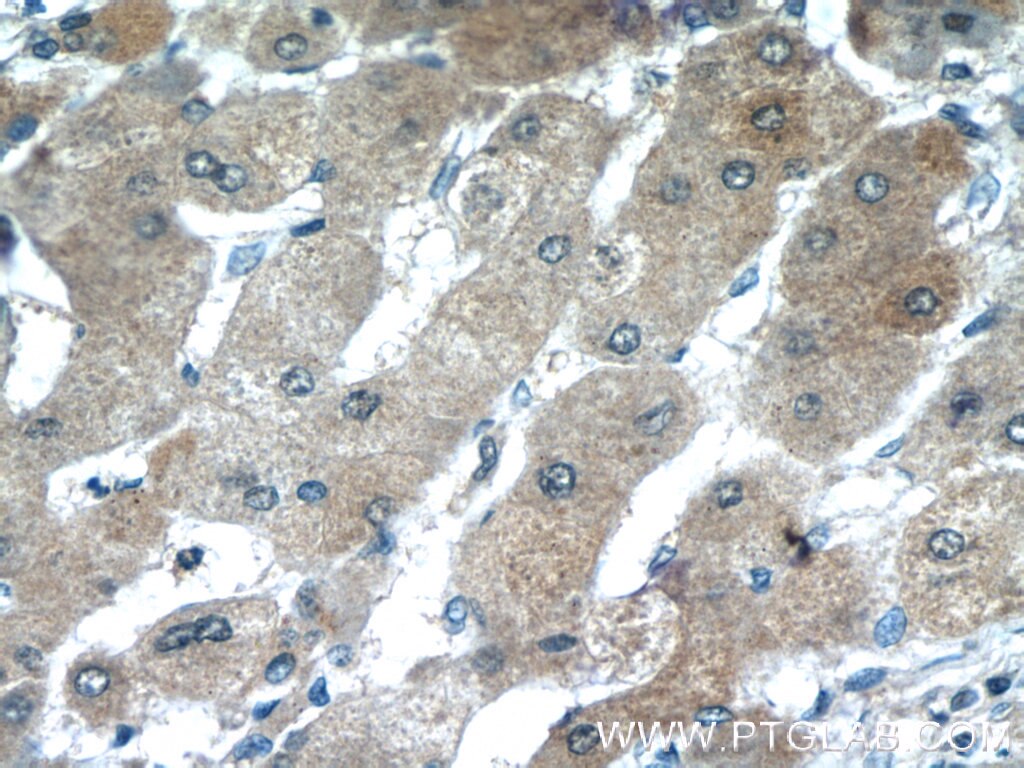 IHC staining of human hepatocirrhosis using 24899-1-AP