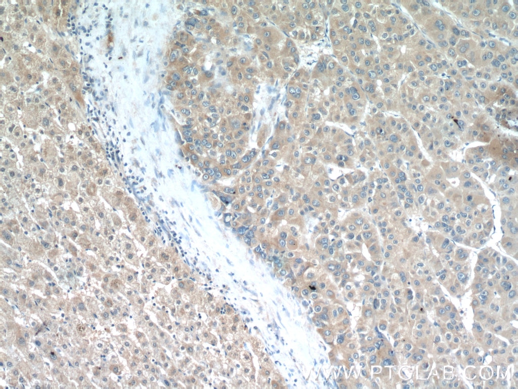 Immunohistochemistry (IHC) staining of human liver cancer tissue using LRP5 Polyclonal antibody (24899-1-AP)