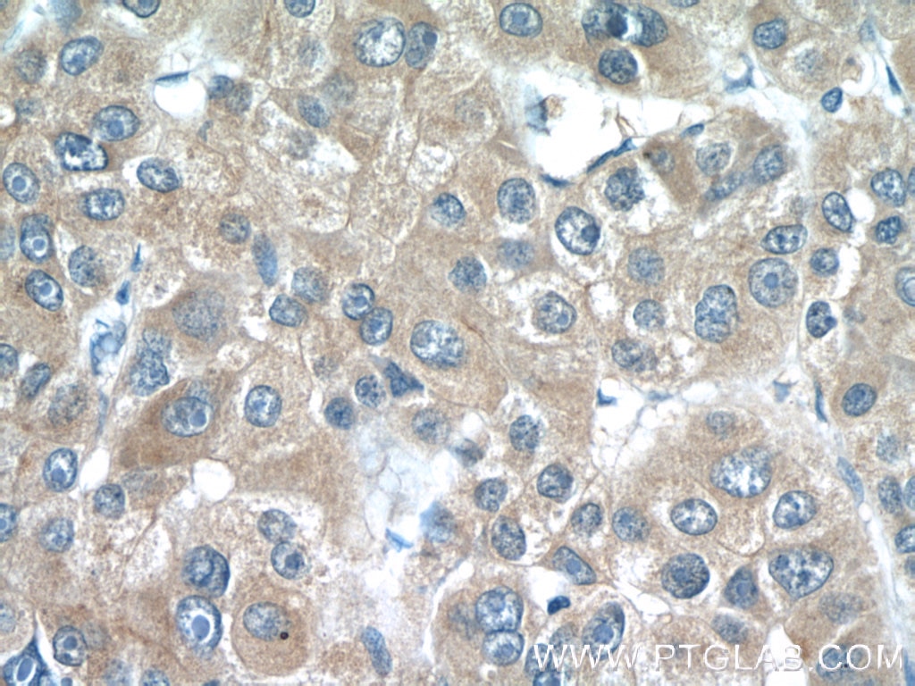 Immunohistochemistry (IHC) staining of human liver cancer tissue using LRP5 Polyclonal antibody (24899-1-AP)