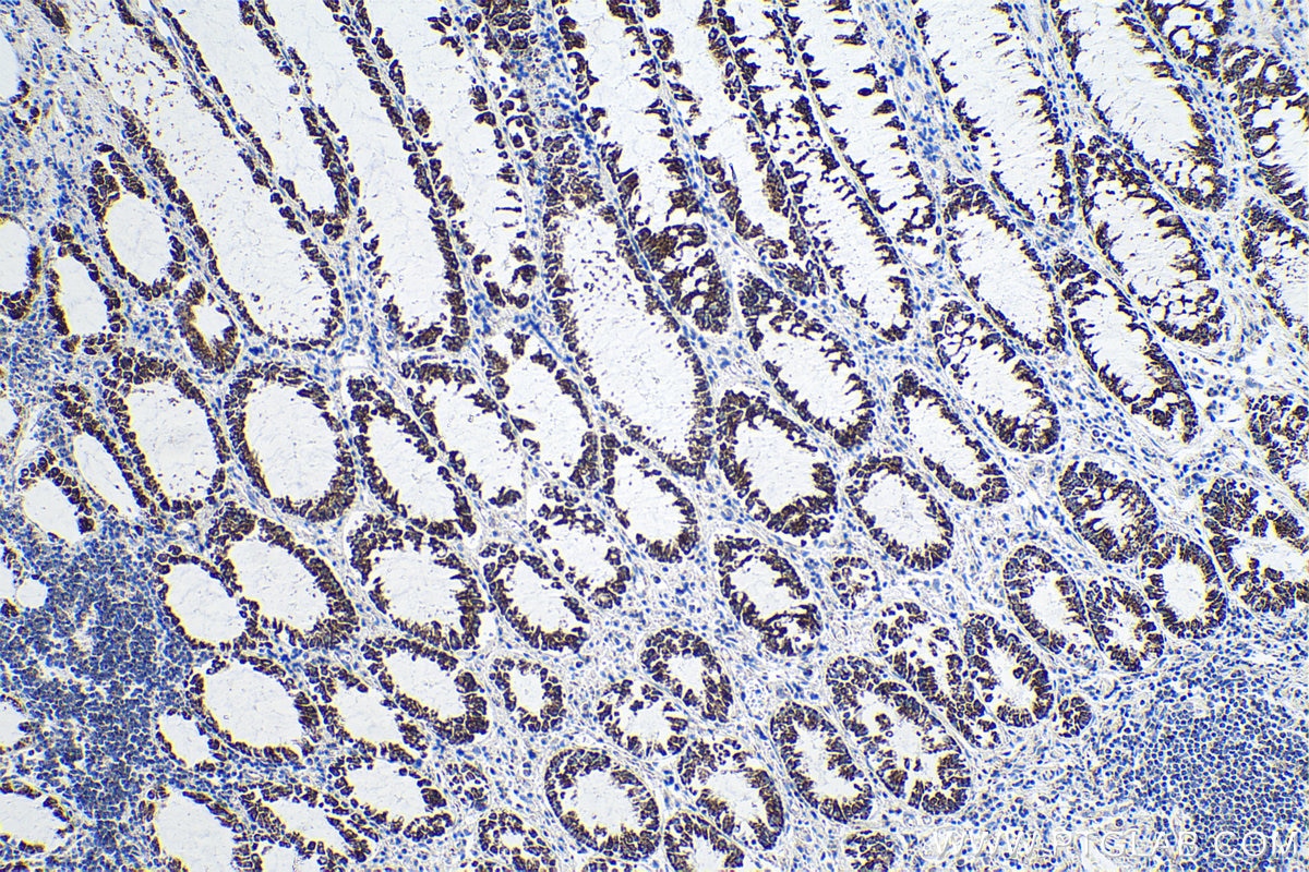 Immunohistochemistry (IHC) staining of human colon cancer tissue using LRPPRC Monoclonal antibody (67679-1-Ig)