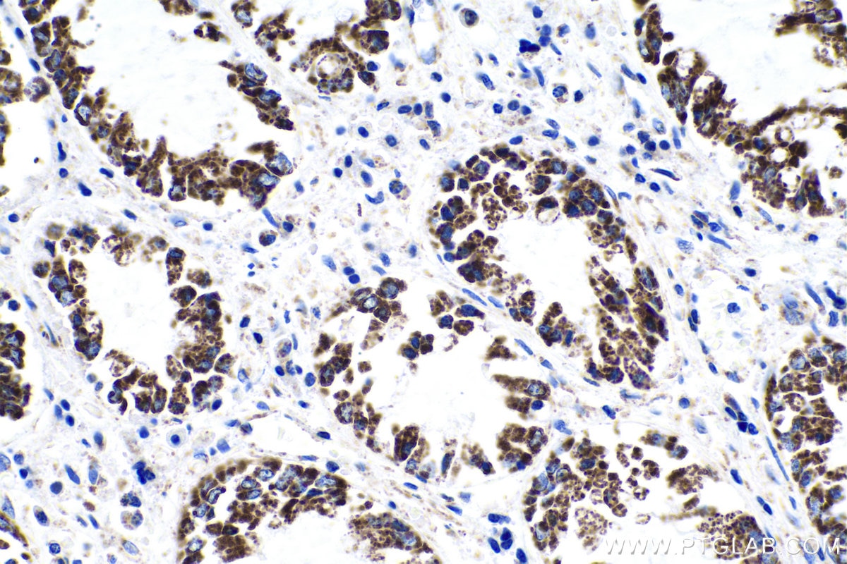 Immunohistochemistry (IHC) staining of human colon cancer tissue using LRPPRC Monoclonal antibody (67679-1-Ig)
