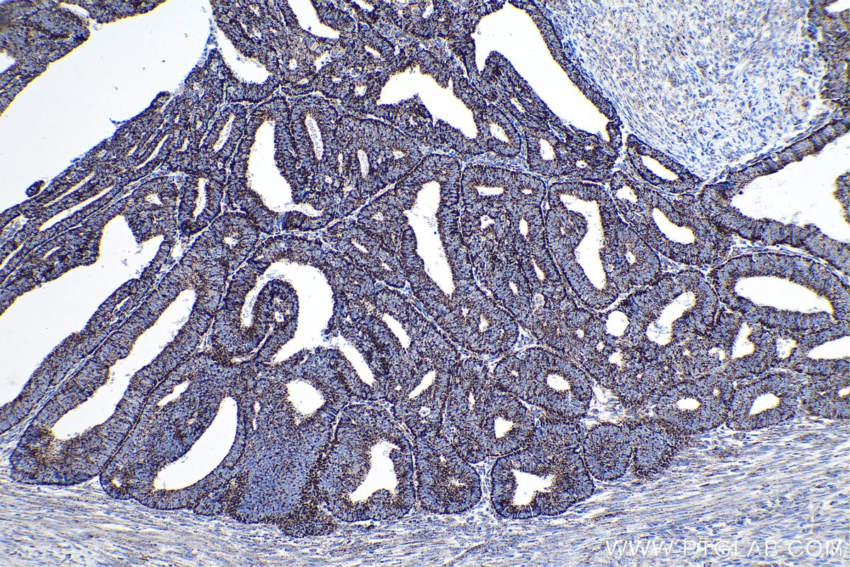 Immunohistochemistry (IHC) staining of human endometrial cancer tissue using LRPPRC Monoclonal antibody (67679-1-Ig)