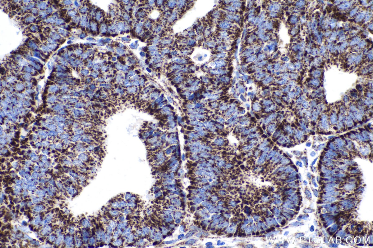 IHC staining of human endometrial cancer using 67679-1-Ig