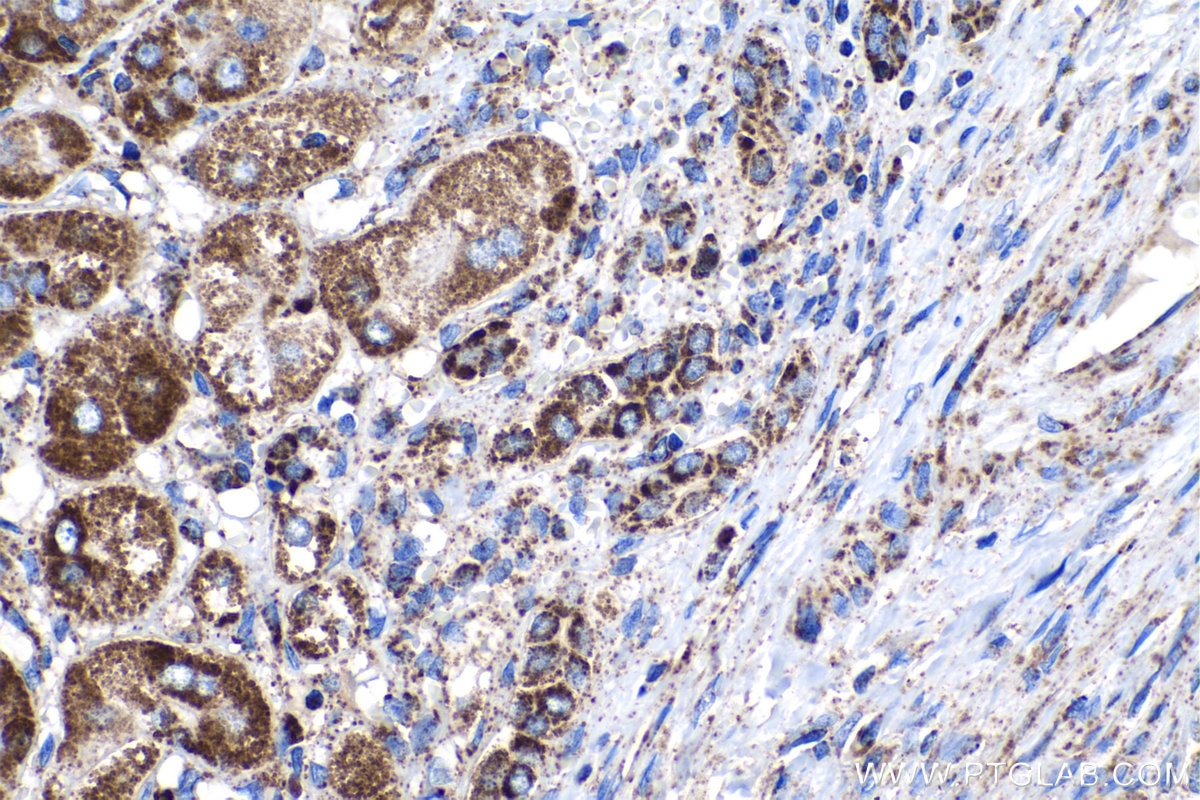 IHC staining of human liver cancer using 67679-1-Ig
