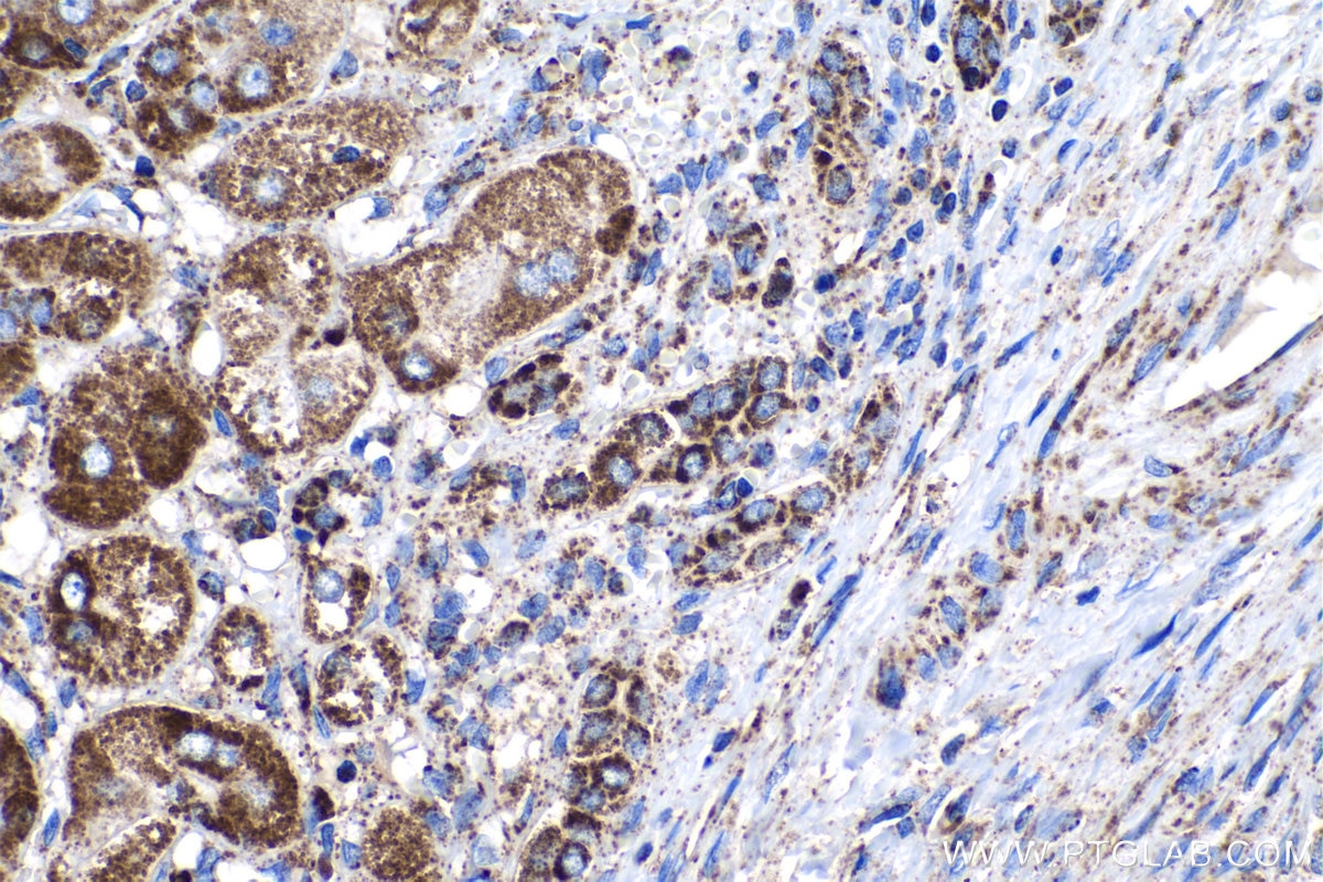 Immunohistochemistry (IHC) staining of human liver cancer tissue using LRPPRC Monoclonal antibody (67679-1-Ig)