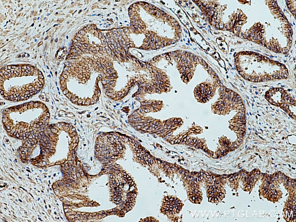 Immunohistochemistry (IHC) staining of human prostate cancer tissue using LRRC1 Polyclonal antibody (10128-2-AP)