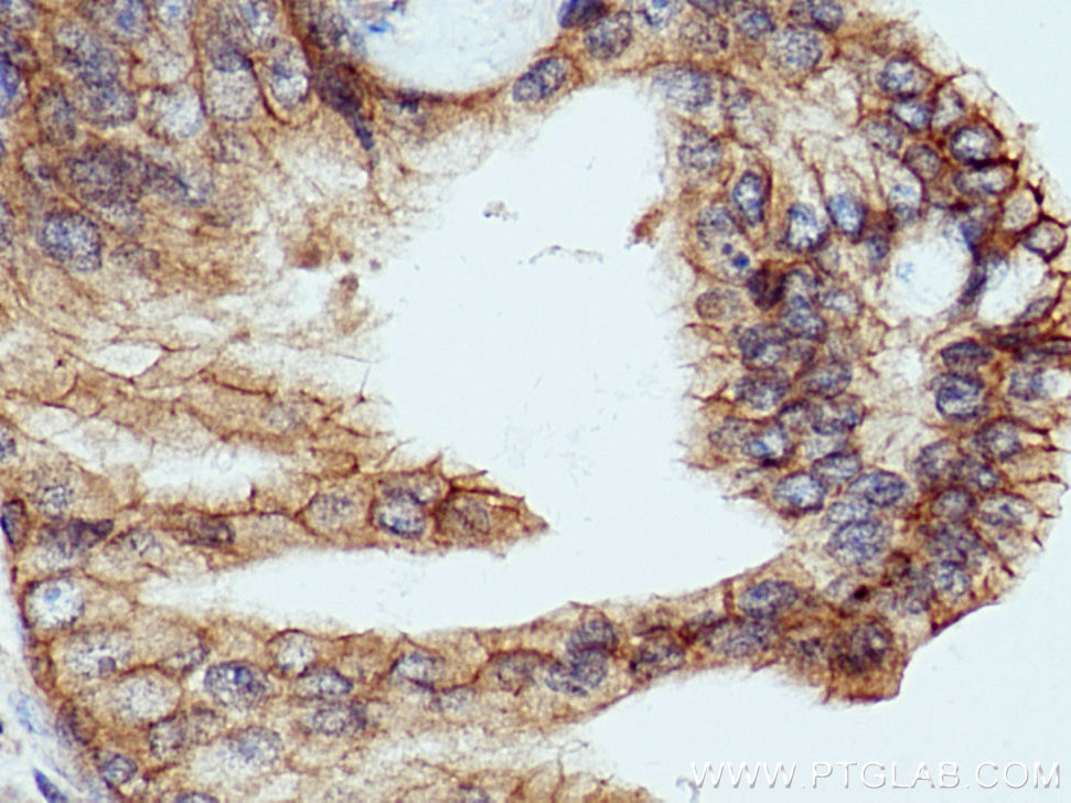 Immunohistochemistry (IHC) staining of human prostate cancer tissue using LRRC1 Polyclonal antibody (10128-2-AP)