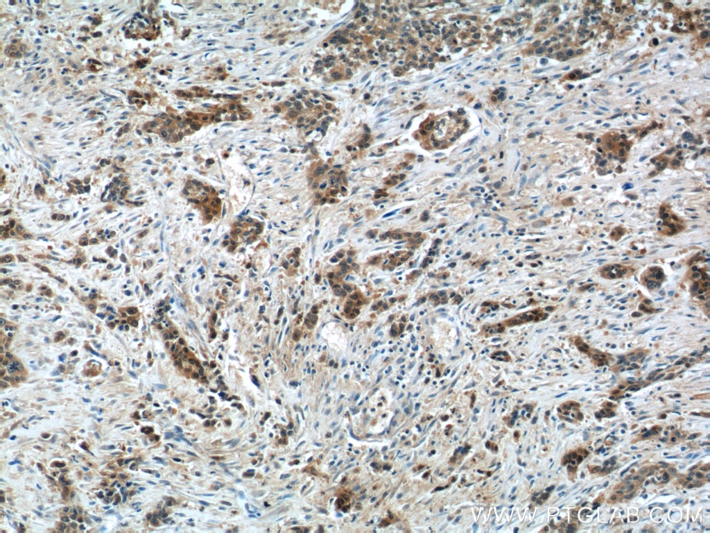 Immunohistochemistry (IHC) staining of human stomach cancer tissue using LRRC20 Polyclonal antibody (25562-1-AP)