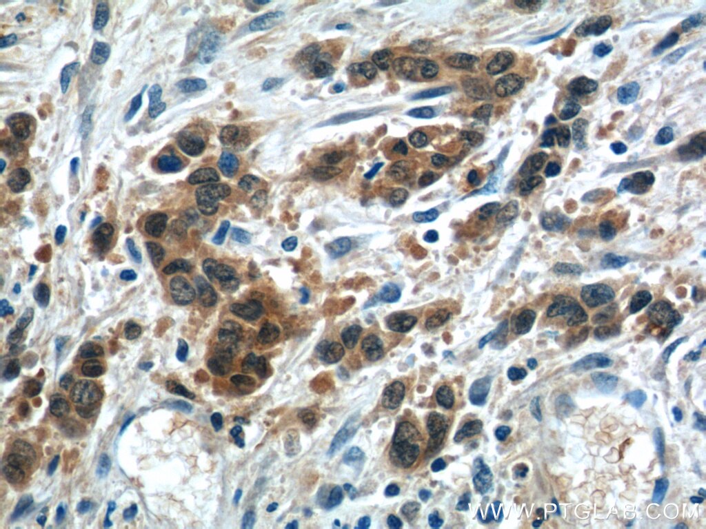 Immunohistochemistry (IHC) staining of human stomach cancer tissue using LRRC20 Polyclonal antibody (25562-1-AP)