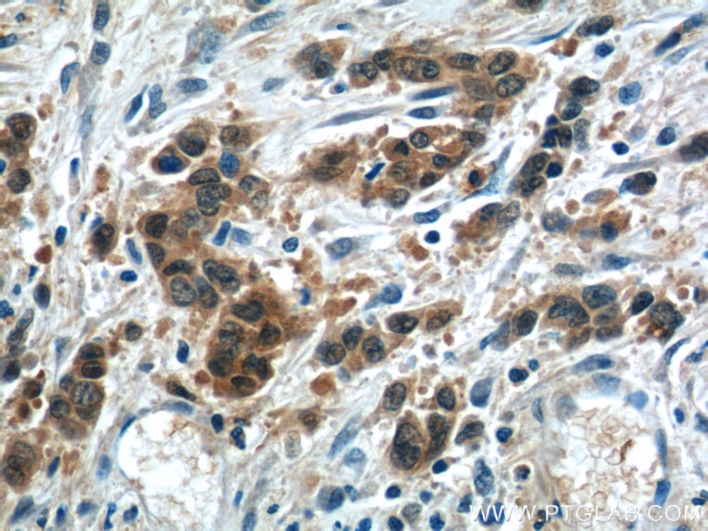 IHC staining of human stomach cancer using 25562-1-AP