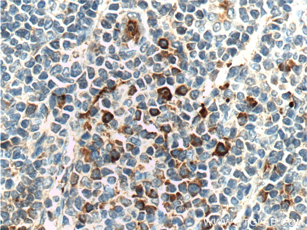 Immunohistochemistry (IHC) staining of human tonsillitis tissue using LRRC32 Polyclonal antibody (26021-1-AP)