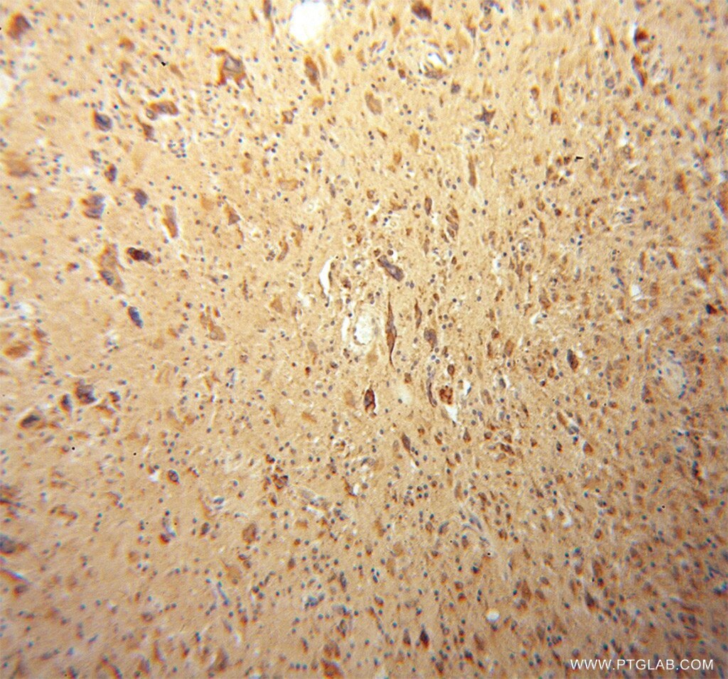 Immunohistochemistry (IHC) staining of human gliomas tissue using LRRC4C Polyclonal antibody (13845-1-AP)