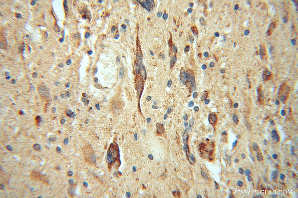 Immunohistochemistry (IHC) staining of human gliomas tissue using LRRC4C Polyclonal antibody (13845-1-AP)