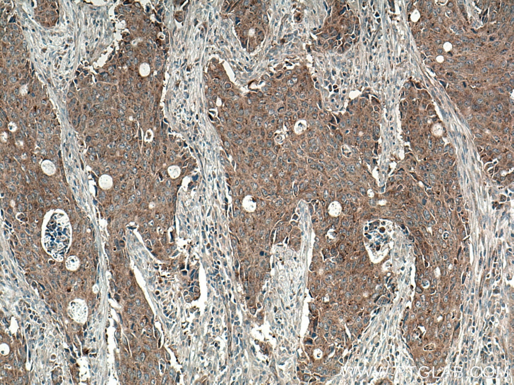 Immunohistochemistry (IHC) staining of human colon cancer tissue using LRRC8A/SWELL1 Polyclonal antibody (17155-1-AP)