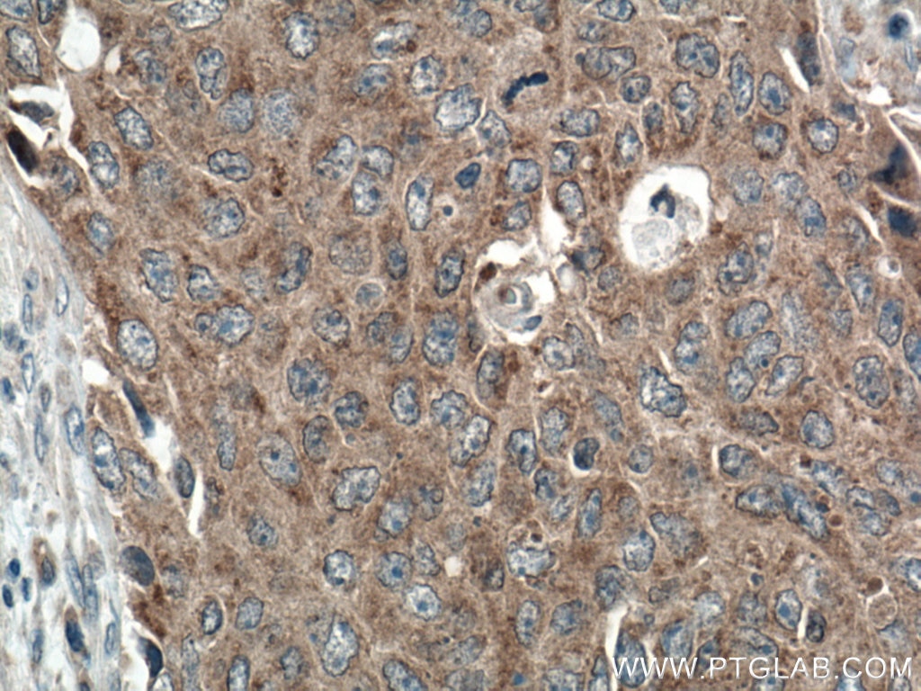 Immunohistochemistry (IHC) staining of human colon cancer tissue using LRRC8A/SWELL1 Polyclonal antibody (17155-1-AP)