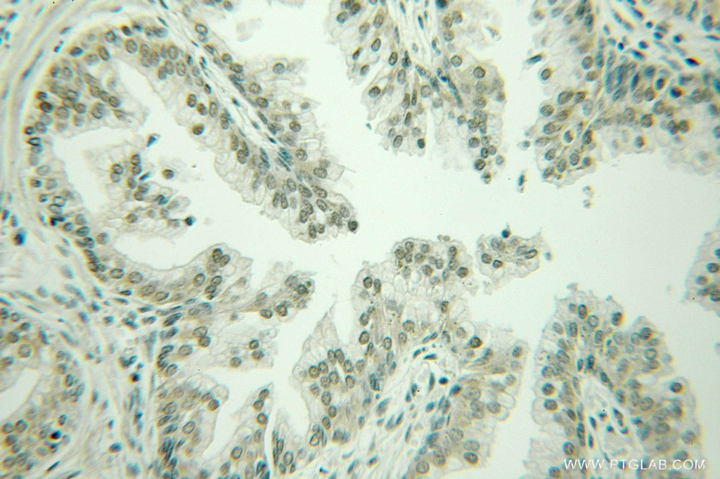 Immunohistochemistry (IHC) staining of human prostate cancer tissue using LSM1 Polyclonal antibody (10259-1-AP)