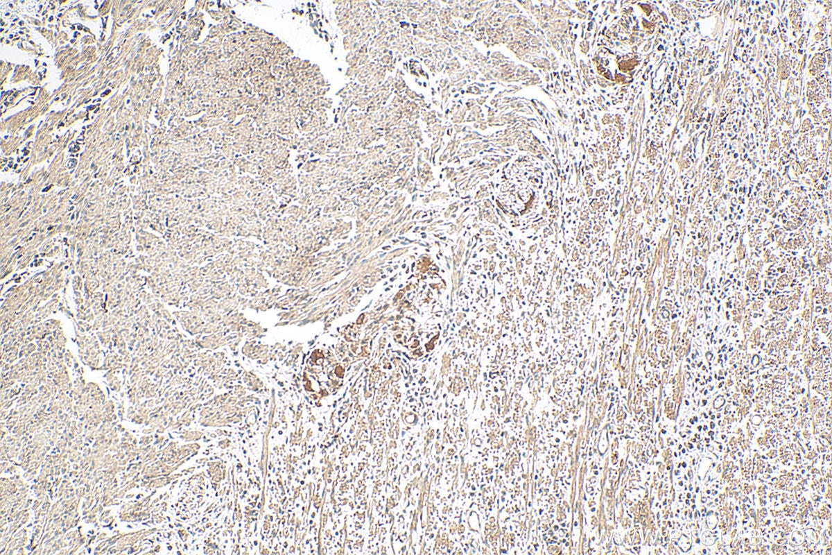 IHC staining of human colon cancer using 67029-1-Ig