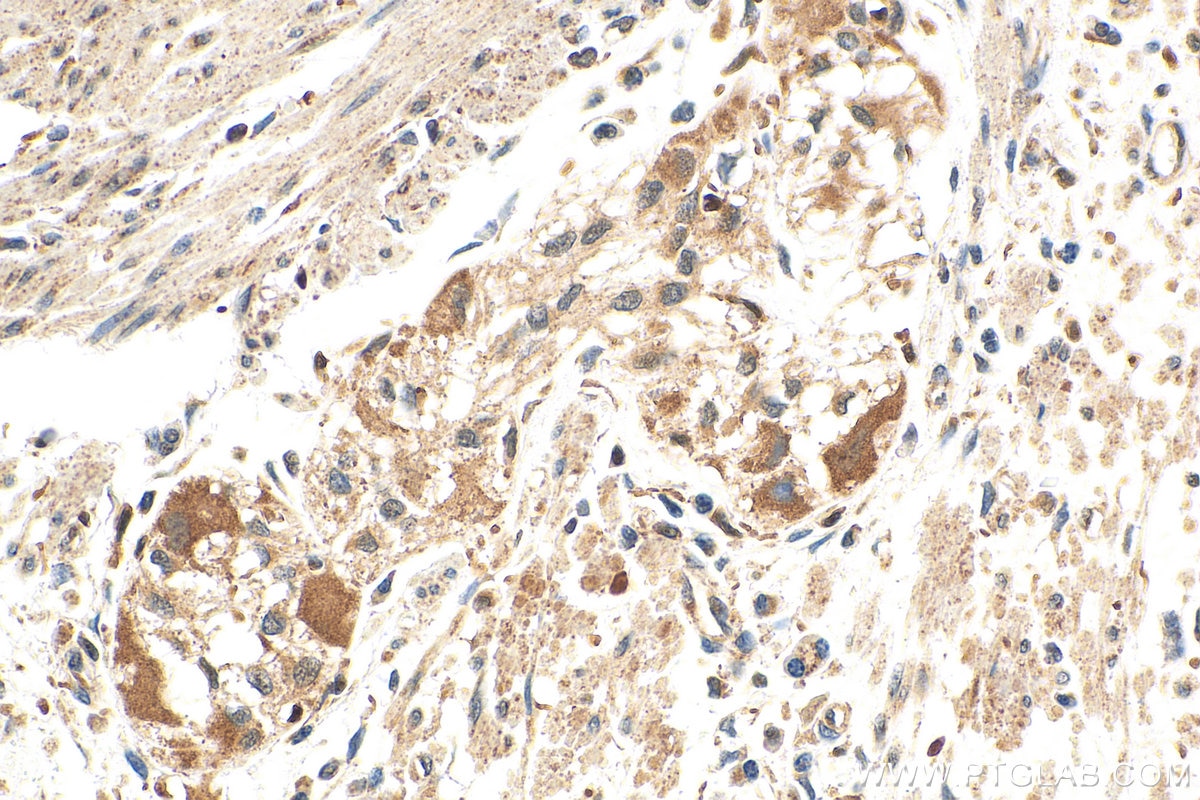 Immunohistochemistry (IHC) staining of human colon cancer tissue using LSM12 Monoclonal antibody (67029-1-Ig)
