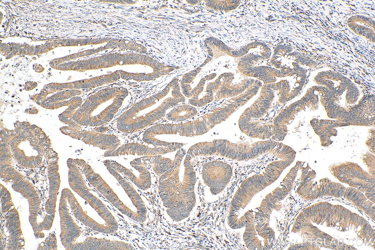 Immunohistochemistry (IHC) staining of human colon cancer tissue using LSM12 Monoclonal antibody (67029-1-Ig)
