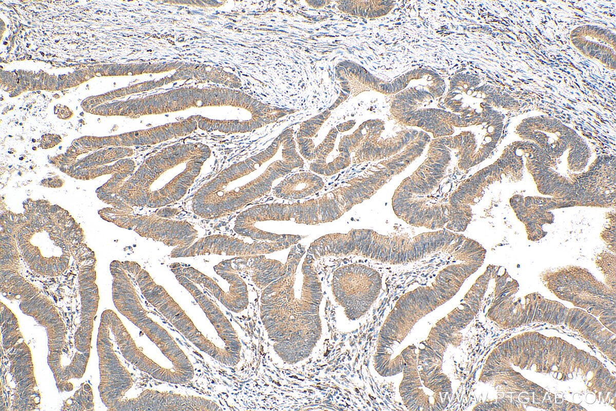 Immunohistochemistry (IHC) staining of human colon cancer tissue using LSM12 Monoclonal antibody (67029-1-Ig)