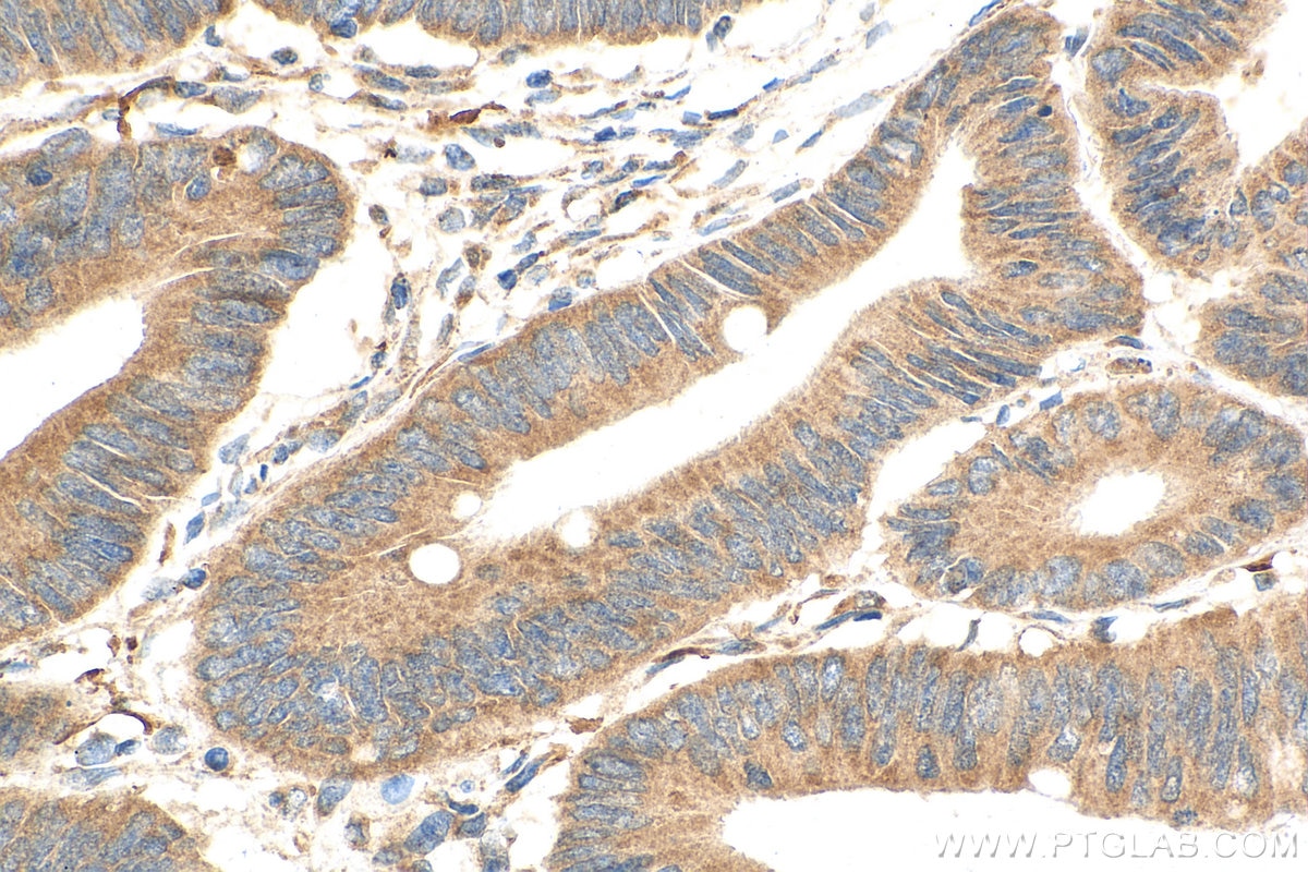 Immunohistochemistry (IHC) staining of human colon cancer tissue using LSM12 Monoclonal antibody (67029-1-Ig)