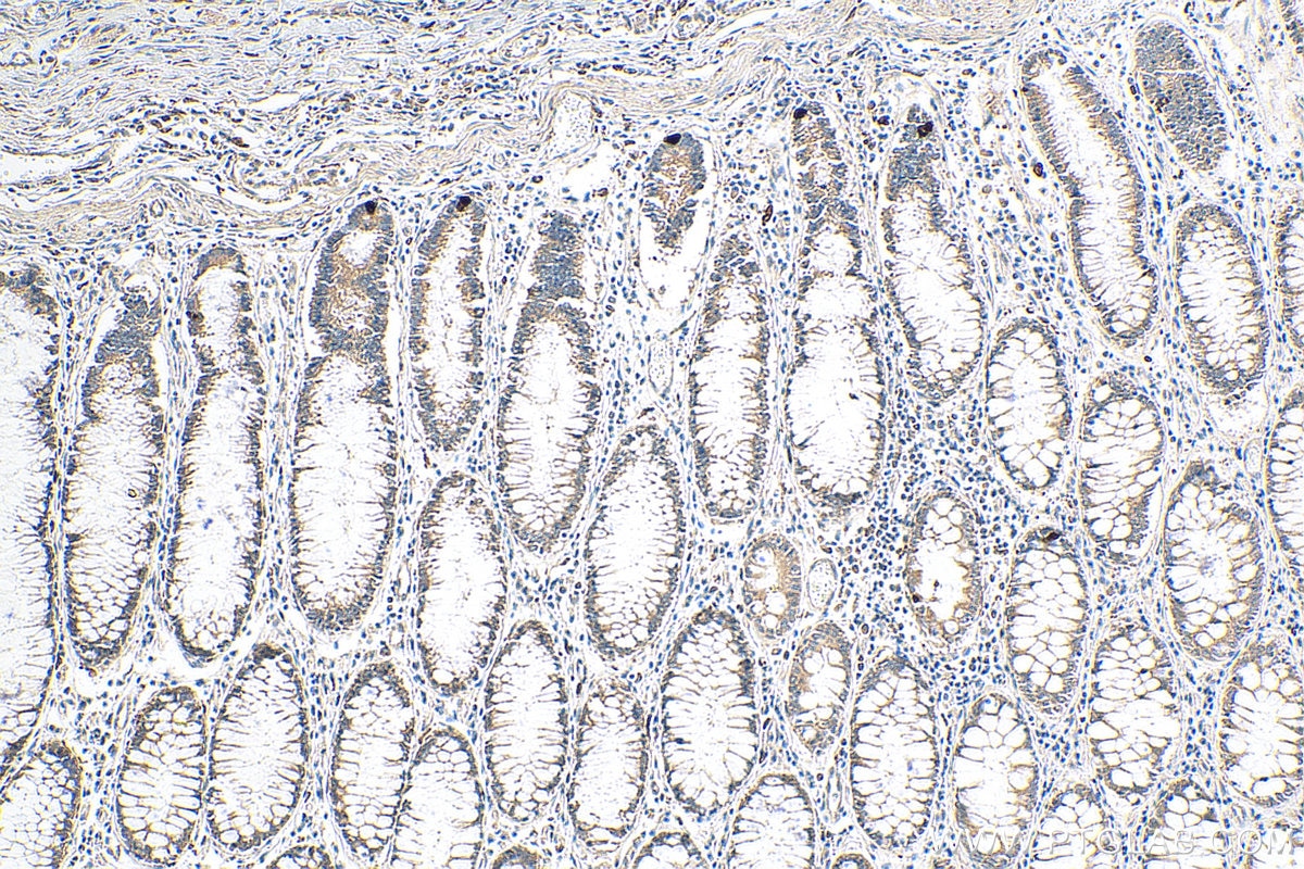 Immunohistochemistry (IHC) staining of human colon cancer tissue using LSM12 Monoclonal antibody (67029-1-Ig)