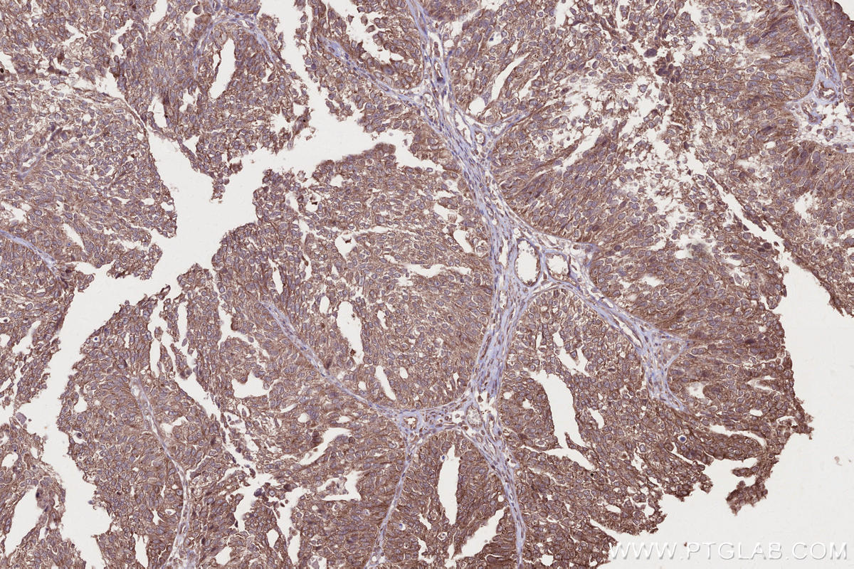 Immunohistochemistry (IHC) staining of human ovary cancer tissue using LSM14A Polyclonal antibody (18336-1-AP)