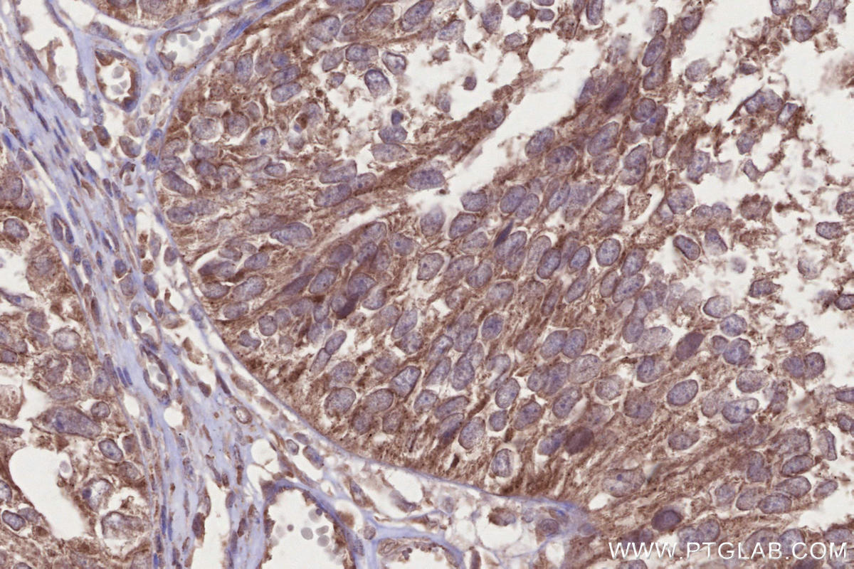 Immunohistochemistry (IHC) staining of human ovary cancer tissue using LSM14A Polyclonal antibody (18336-1-AP)