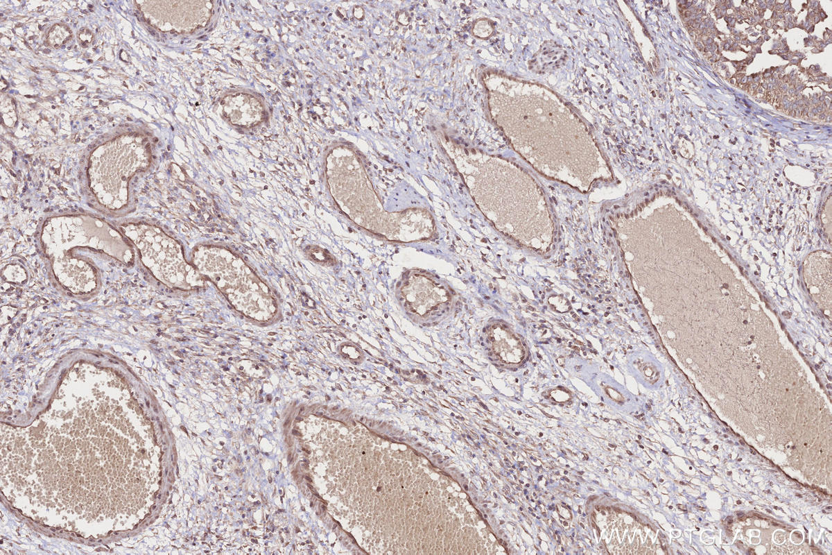 Immunohistochemistry (IHC) staining of human ovary cancer tissue using LSM14A Polyclonal antibody (18336-1-AP)