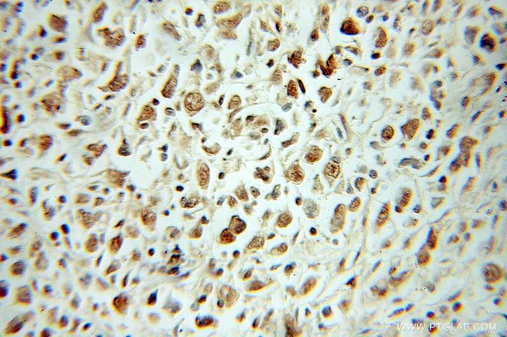 Immunohistochemistry (IHC) staining of human lymphoma tissue using LSM2 Polyclonal antibody (10963-1-AP)
