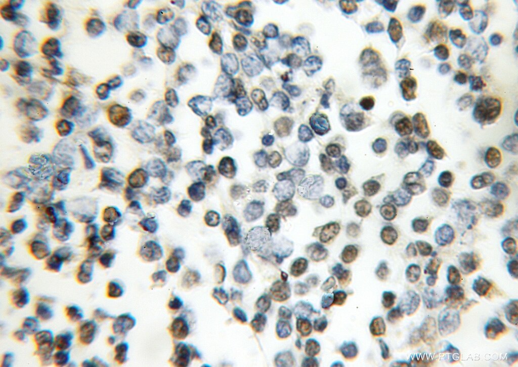 Immunohistochemistry (IHC) staining of human lymphoma tissue using LSM2 Polyclonal antibody (10963-1-AP)