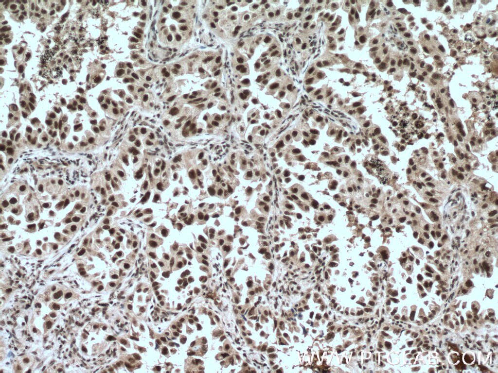 Immunohistochemistry (IHC) staining of human lung cancer tissue using LSM4 Polyclonal antibody (10834-1-AP)